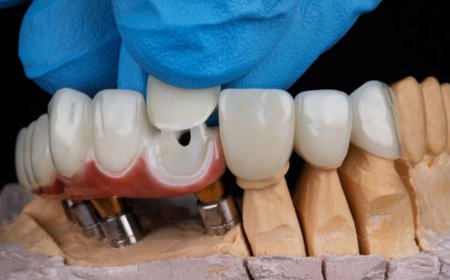 How Long Does a Temporary Crown Last and What to Expect