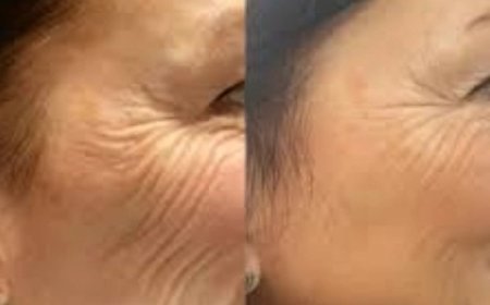 Ignite Glow Using Profhilo at the Best Aesthetic Clinics in dubai