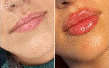 How to Prepare for a Juvederm Event Look at the Best Aesthetic Clinics in Dubai