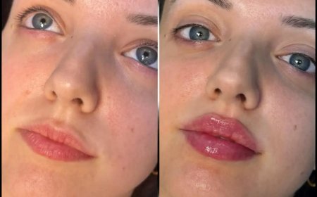 Best Aesthetic Clinics in dubai for Fillers: Managing Expectations for Realistic Outcomes