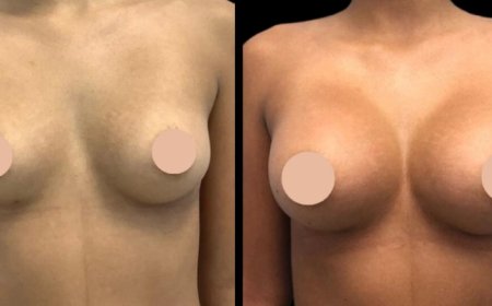 Breast Augmentation in Dubai: What Patients Love Most