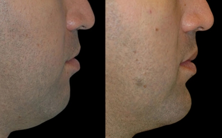 Best Aesthetic Clinics in Dubai for Chin Fillers: Sculpt a Defined Jawline