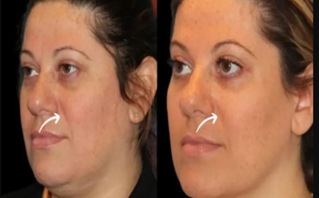 Innovations in Injection Techniques for Sculptra Fillers in Dubai