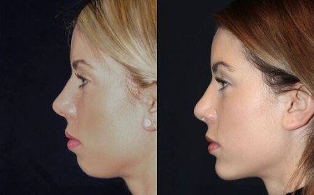 Chin Fillers in Dubai: Personalized Facial Enhancements