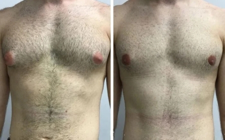 How the Best Gynecomastia Surgeons in Dubai Handle Complex Cases