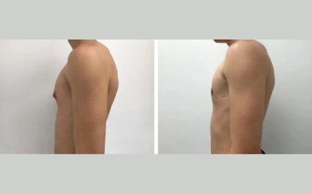 Why the Best Doctors in Dubai Are Experts in Male Boob Reduction Surgery