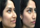 Exploring the Cost and Benefits of Rhinoplasty Islamabad