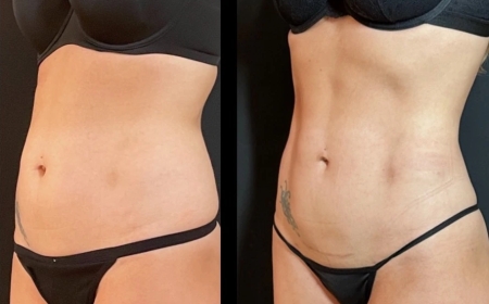 Tummy Tuck Surgery Dubai for Post-Pregnancy Body Restoration