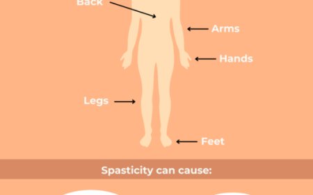 Managing Muscle Tightness in Multiple Sclerosis: What Works