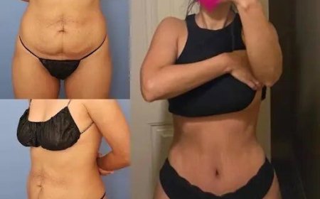 A Comprehensive Guide to the Best Tummy Tuck Surgeons in Dubai