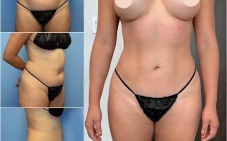 What the Best Body Contouring Surgeons in Dubai Recommend for a Faster Recovery
