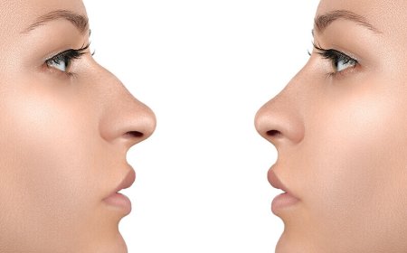 Benefits of Ultrasonic Rhinoplasty in Dubai Over Traditional Nose Jobs