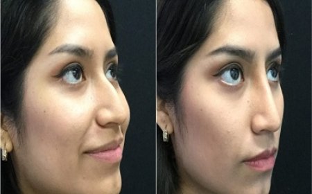 Exploring the Cost and Benefits of Rhinoplasty Islamabad