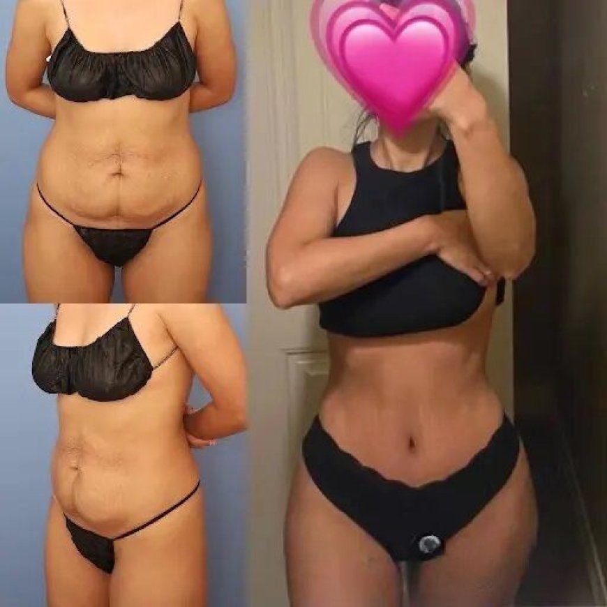 A Comprehensive Guide to the Best Tummy Tuck Surgeons in Dubai