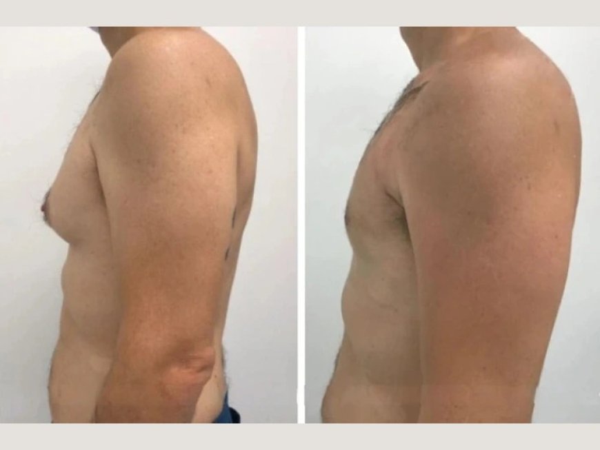 How the Best Gynecomastia Surgeons in Dubai Can Improve Your Self-Esteem and Confidence